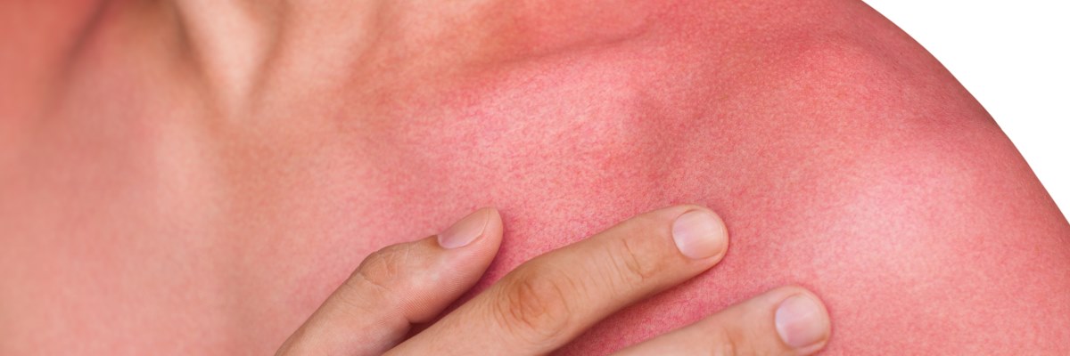 Salute della pelle: dermatiti ed esposizione solare. Che fare?