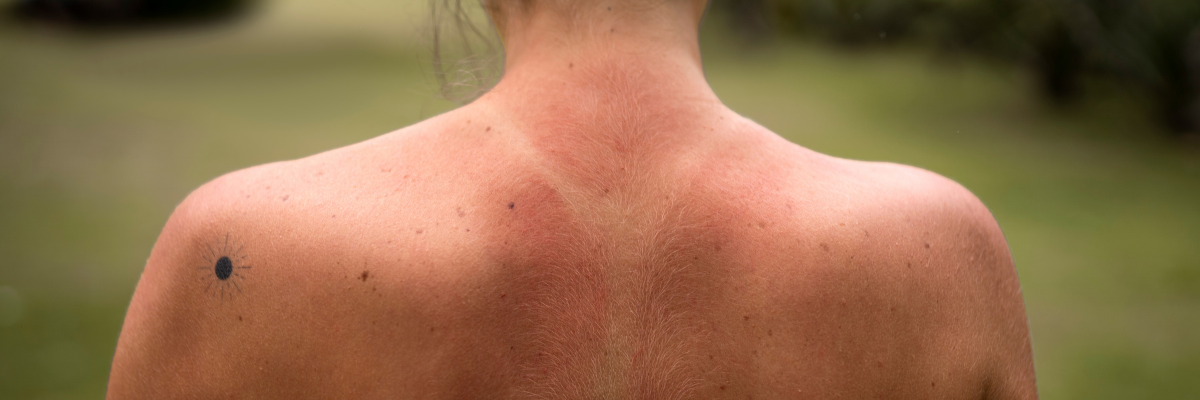 Prevenzione del melanoma, 5 regole su come vestirsi per proteggere la pelle