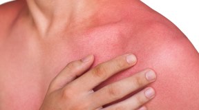 Salute della pelle: dermatiti ed esposizione solare. Che fare?