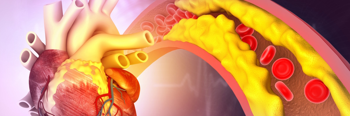 Colesterolo e rischio cardiovascolare 